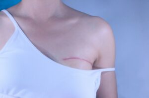 cicatrice-cancer-du-sein